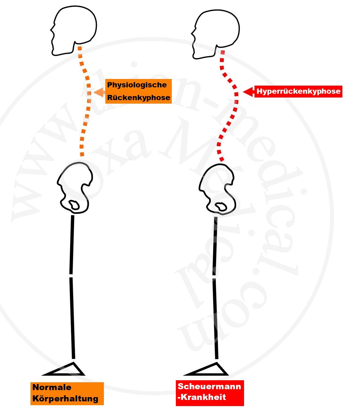 Diagramm der Scheuermann-Krankheit